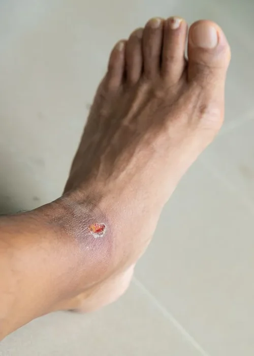 Diabetic-Foot-Ulcer-02-640w.webp